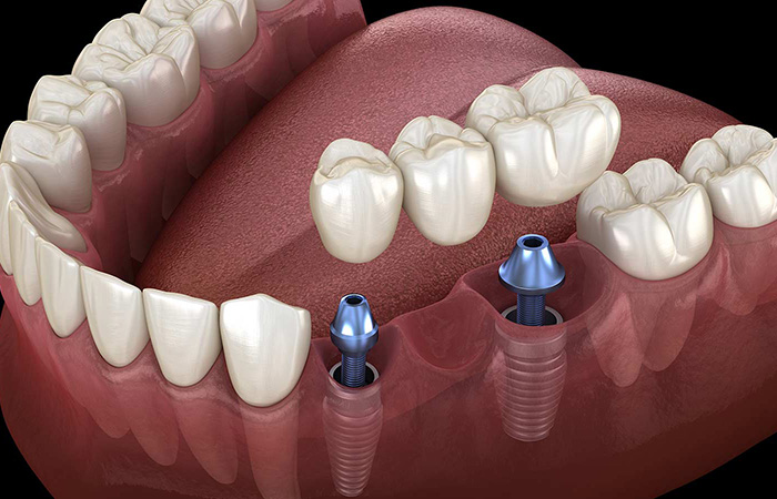 Dental-implants