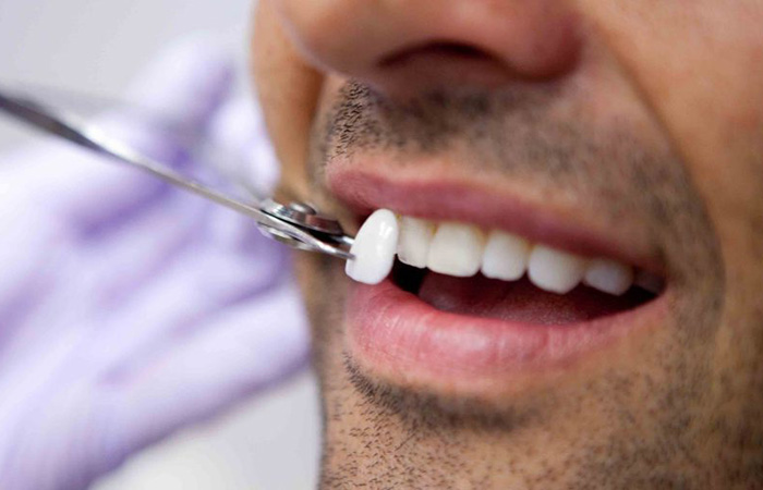 Porcelain-Veneers